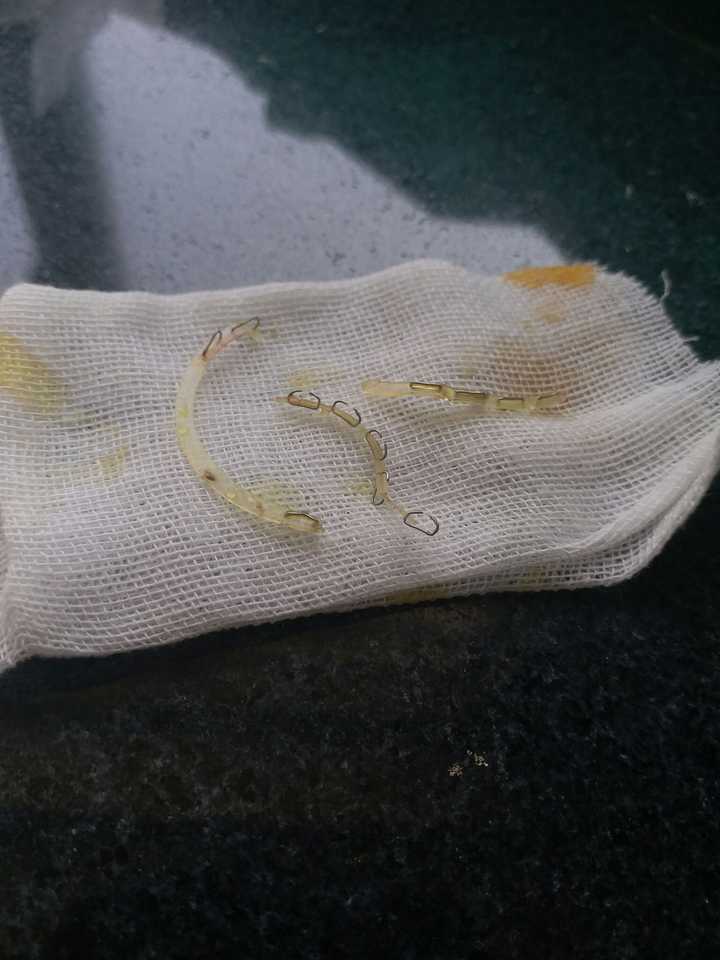 环切术后的样子_术切环图片后月经正常吗_环切术后3个月图片