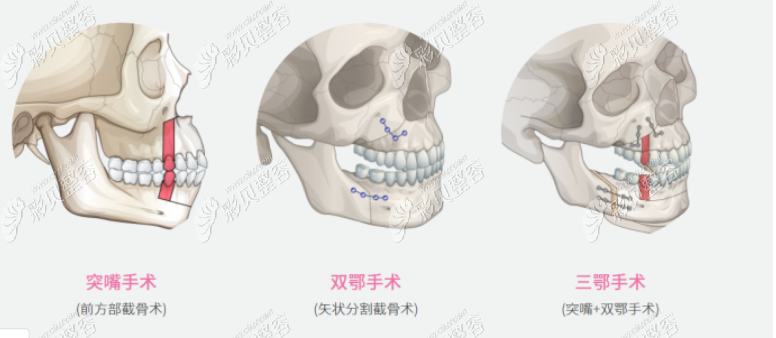 面部提升嘴巴歪了_大v线提升有副作用吗_大v线提升后嘴巴歪了