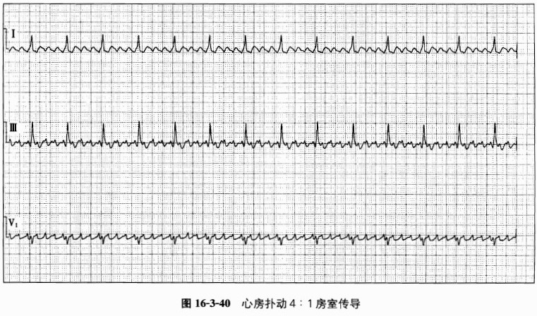 阵发性心房扑动的治疗_阵发性心房扑动吃什么药_阵发性室上性心动过扑