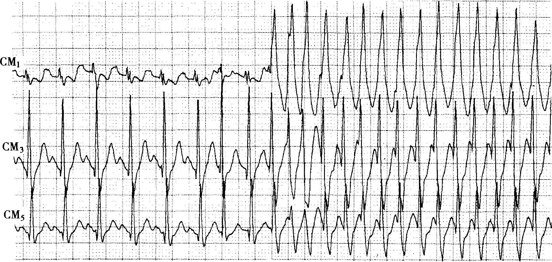 阵发心动过速怎么治疗_阵发性心动过速严重吗_阵发性心动过速怎么急救